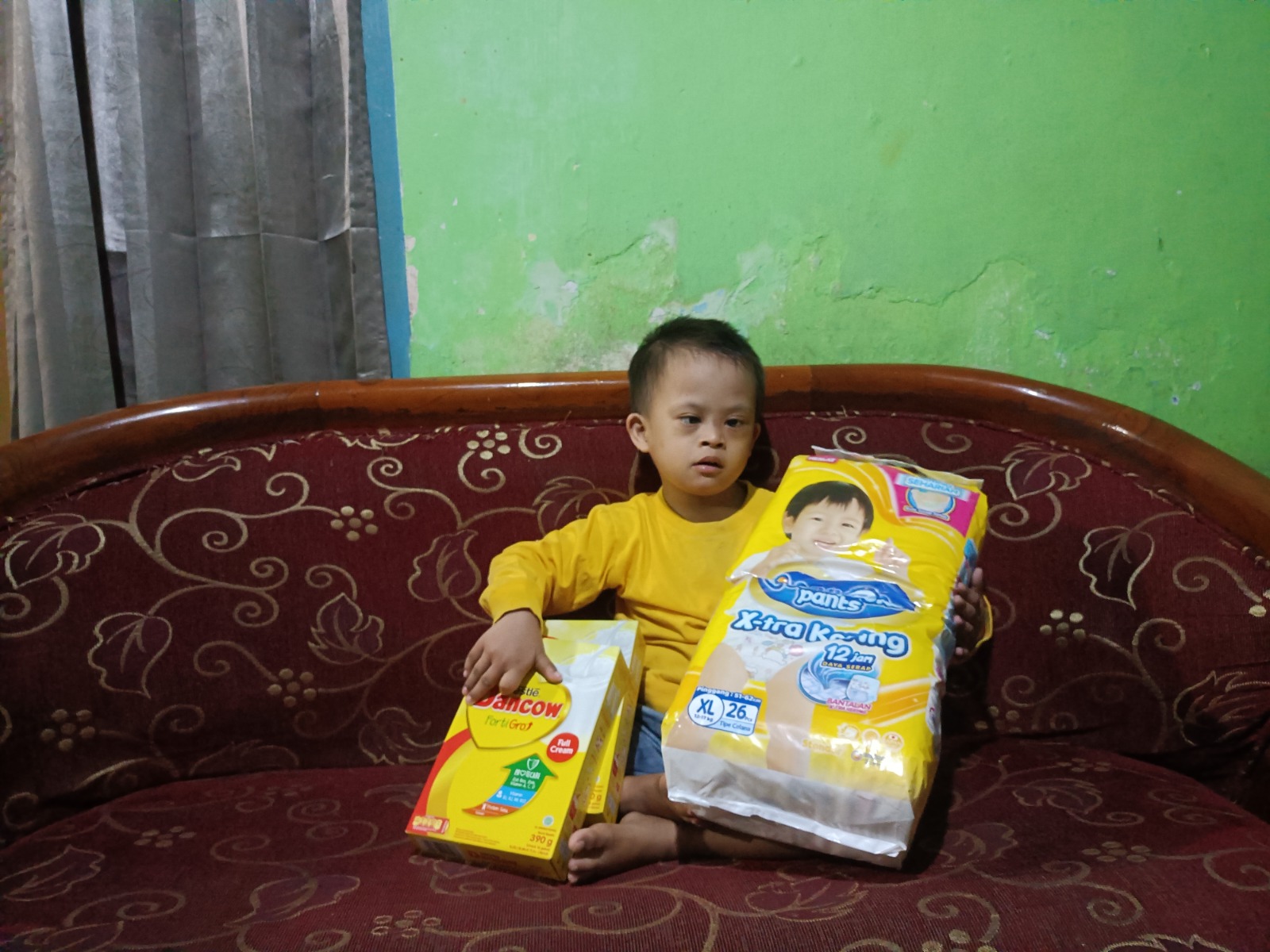 Kasus down syndrome, down syndrome, susu, nutrisi